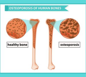 , Preventing Osteoporosis: The Benefits of Screening and Lifestyle Choices