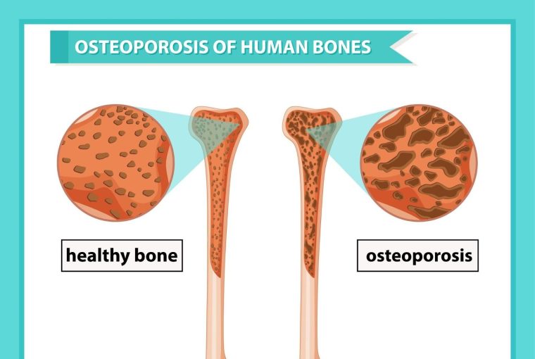 , Preventing Osteoporosis: The Benefits of Screening and Lifestyle Choices